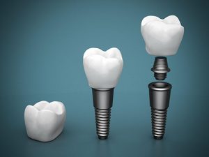 Dental Implants | Dentist Glenroy