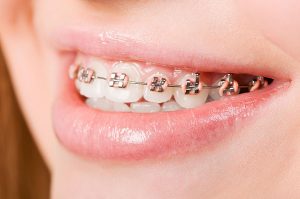 Orthodontics | Dentist Glenroy