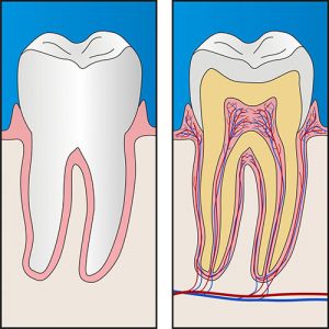 Root Canal Treatment | Dentist Glenroy