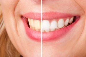 Teeth Whitening | Dentist Glenroy