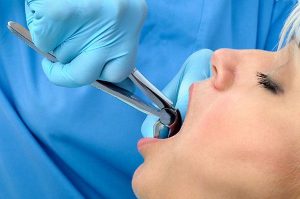 Tooth Extractions | Dentist Glenroy