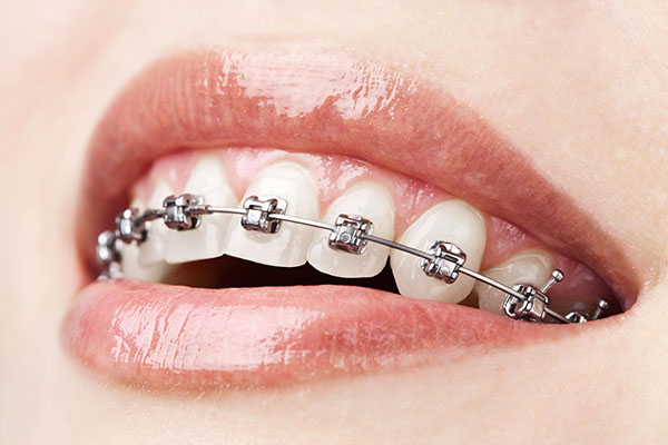 Dental Braces in Dentist Glenroy | The Glenroy Dental Group