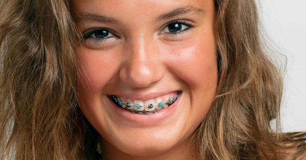 All About Braces