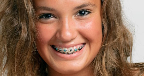 all-about-braces-glenroy-dentist-f