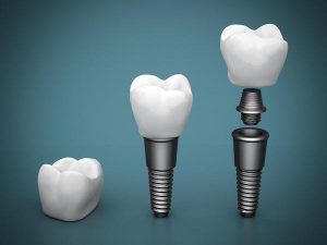 The Dental Implant Advantage