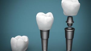The Dental Implant Advantage