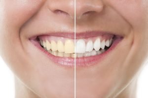 How To Whiten Yellow Teeth Instantly