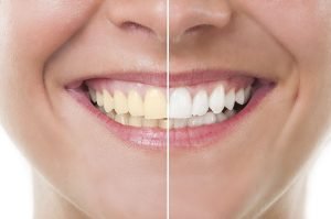 Yellow Teeth Top Causes and Treatments glenroy dentist