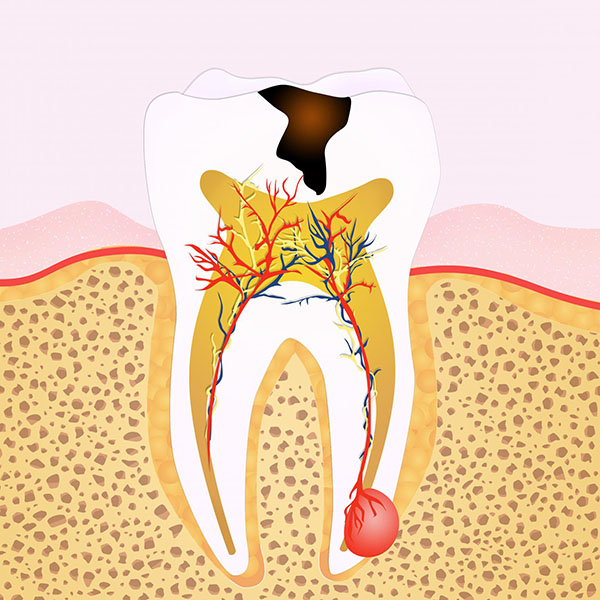 tooth that needs root canal