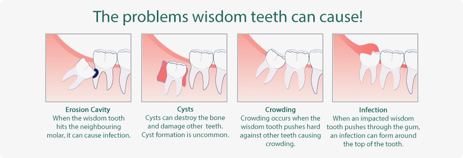 Wisdom Tooth Extraction in Glenroy