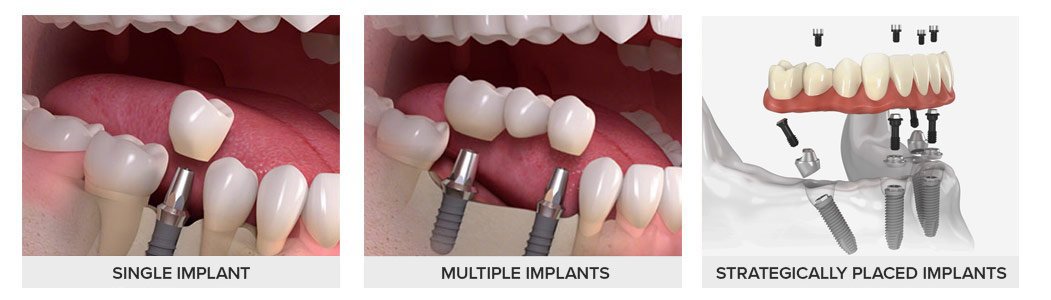 Single Multiple All on 4 impalnts