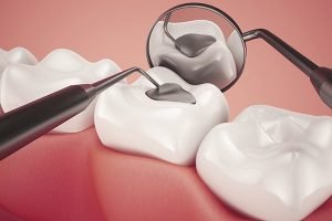 The Glenroy Dental Group | Lost Damaged Fillings Crowns And Inlays Onlays | Dentist Glenroy