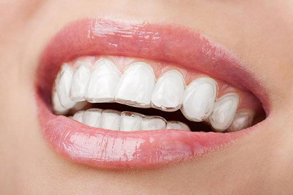 The Advantages Of Invisalign For Your Teen’s Smile
