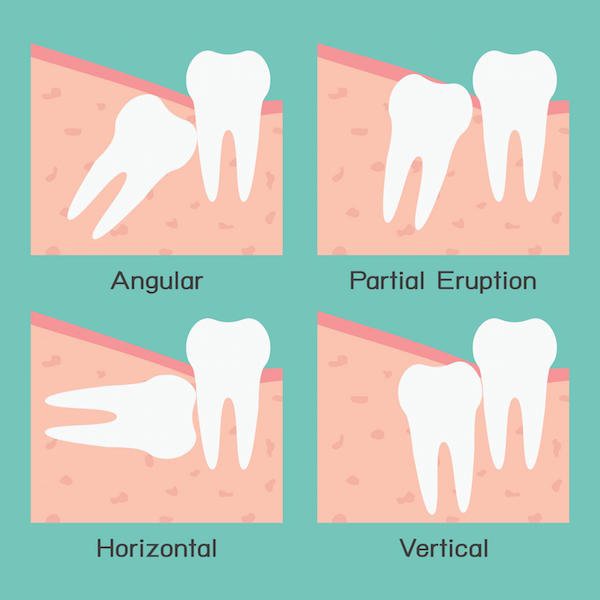 Extracting Wisdom Teeth and Aftercare