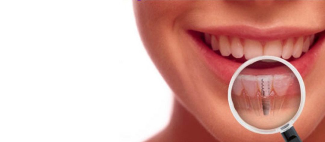 Are Dental Implants Right for You?