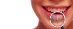 Dental Implants