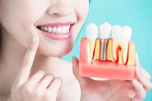 Dental Implants in Glenroy