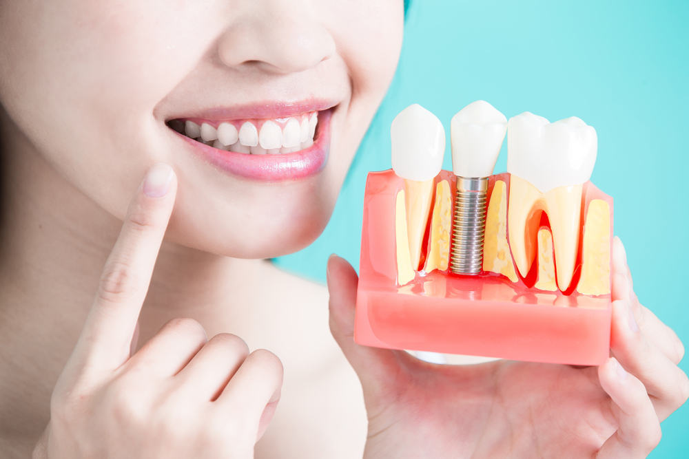 Is it Possible to Find Affordable and High-Quality Dental Implants in Glenroy?