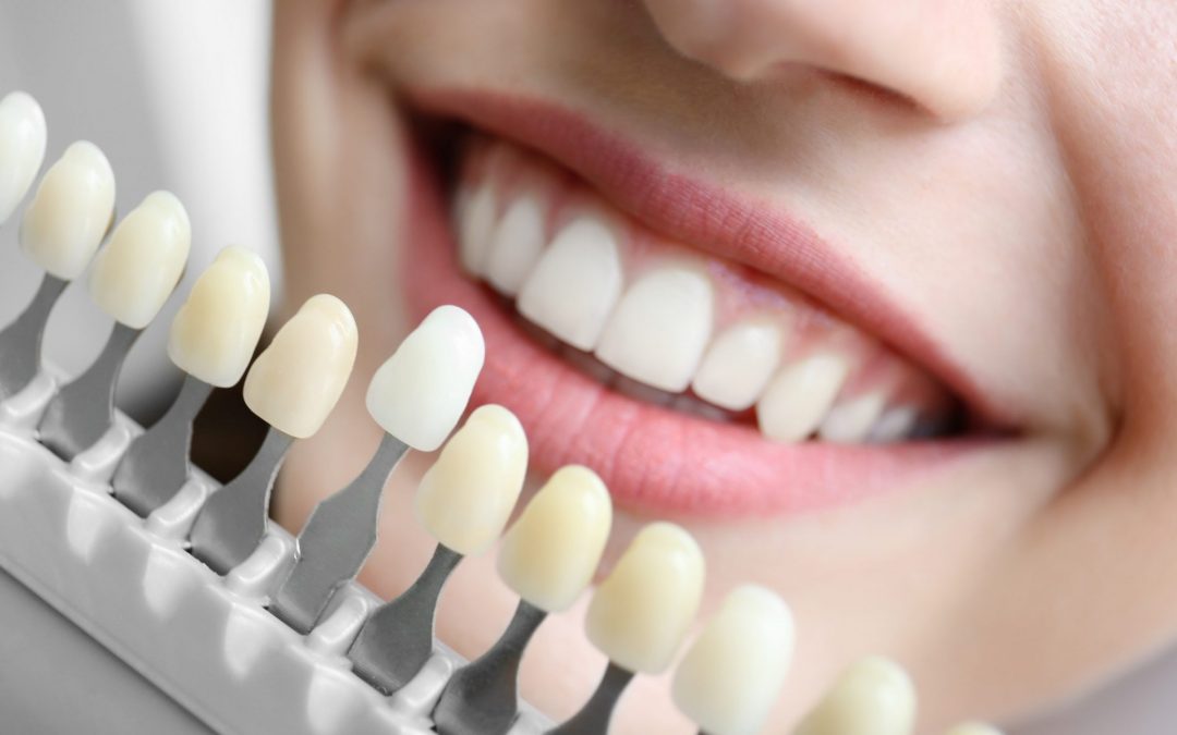 Affordable Modern Dental Implants in Glenroy