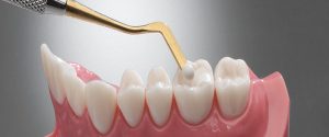 Glenroy Dental Guide – How Long Can You Expect A Dental Filling To Last
