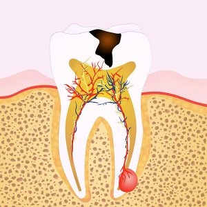 Dentist Glenroy Guide : What Are the Signs that You Need Root Canal Treatment