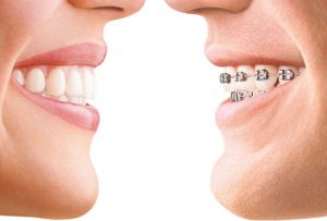 Top 3 Most Popular Braces Options For Adults