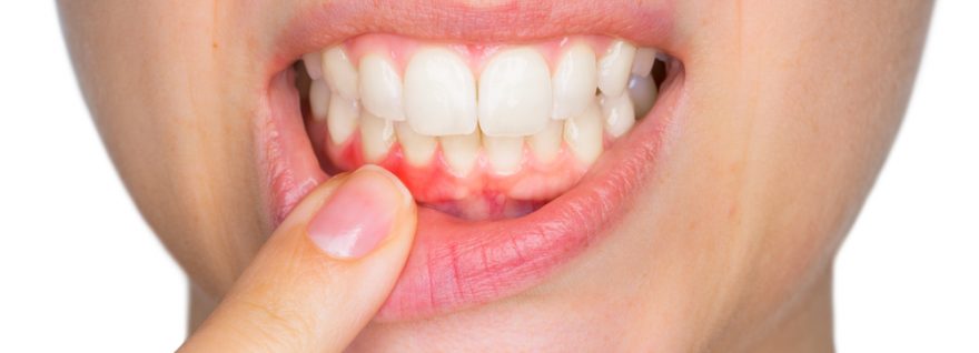 Gum Disease – The "Cure" Is Treatment, Then Prevention