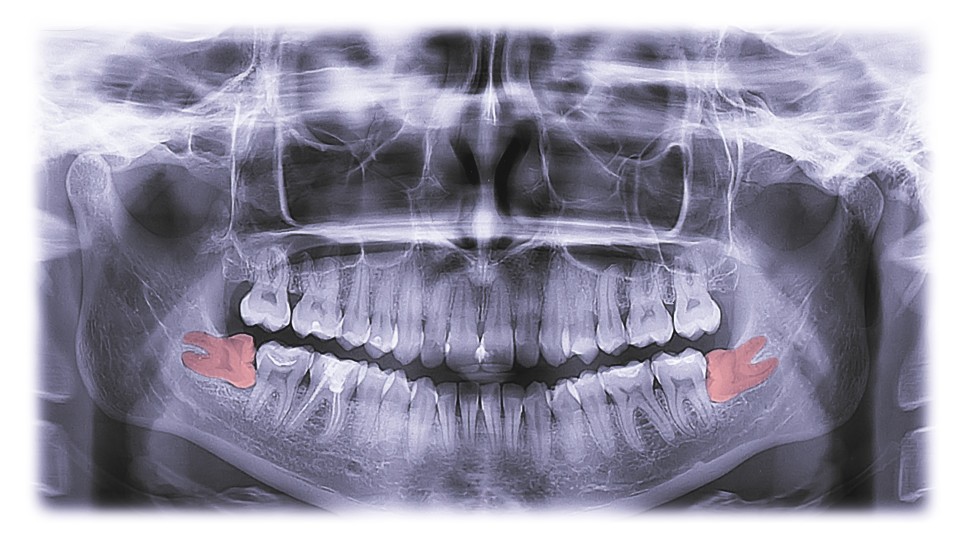 wisdom-teeth-removal-glenroy
