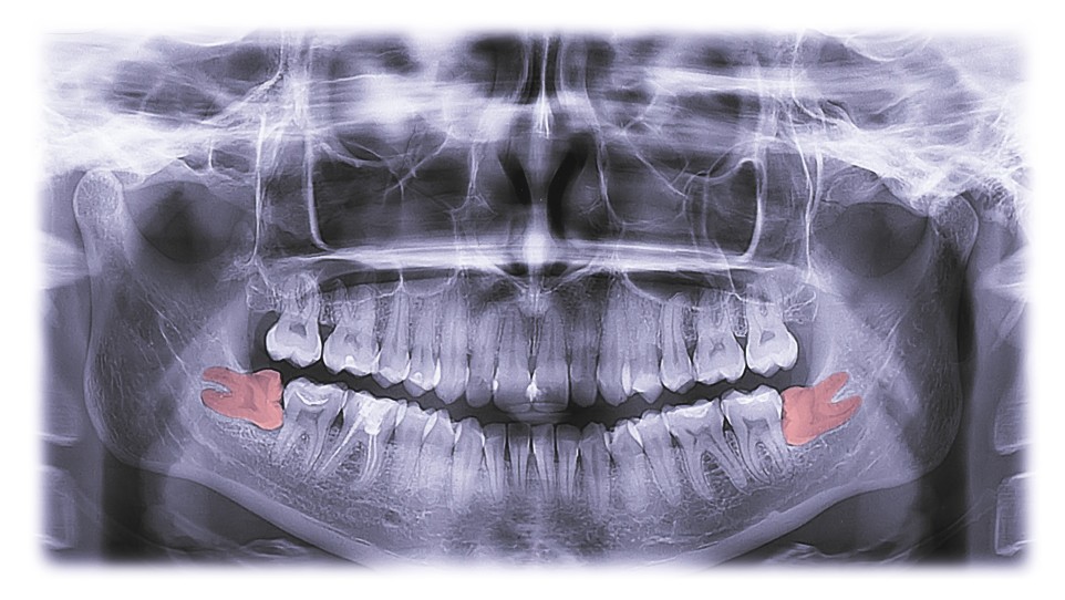 wisdom teeth removal aspendale