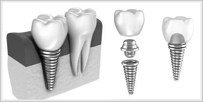 Titanium Dental implant