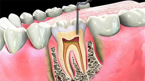 Is Root Canal Treatment Painful