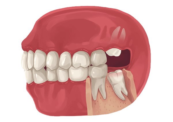 wisdom teeth before and after