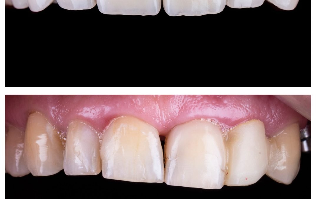 5 Great Tips to Look After Your Porcelain Veneers to Keep it Clean!