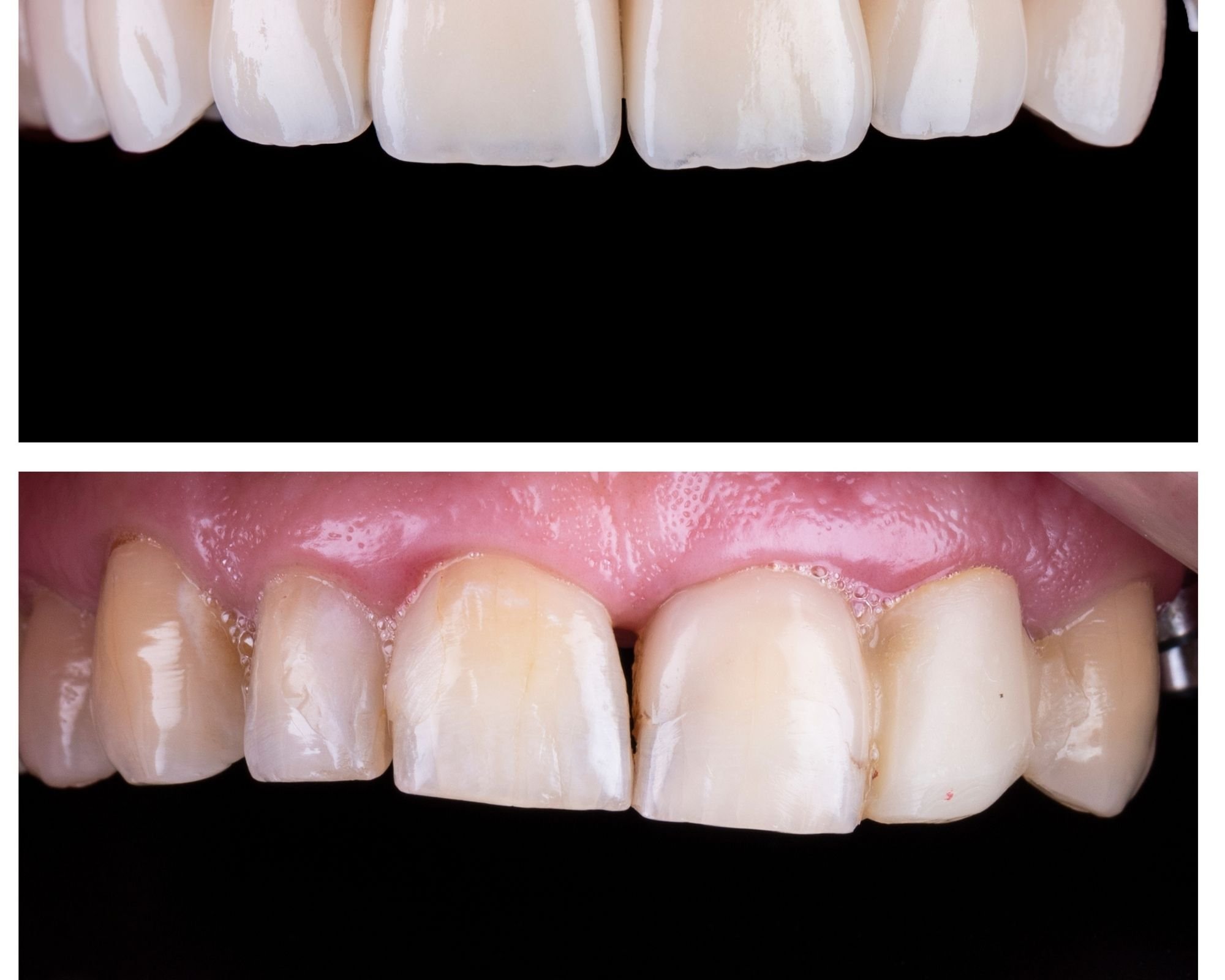 Look After Your Porcelain Veneers Glenroy Dental Group