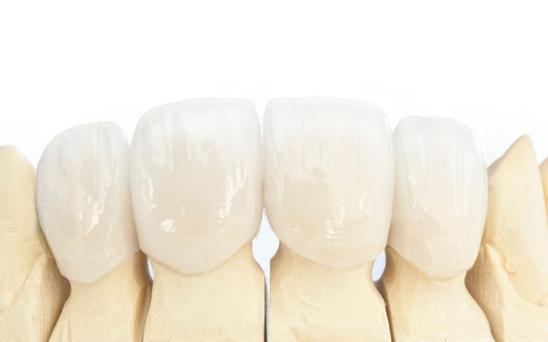 5 Tips from Dental Experts for Taking Care of Your Dental Crown