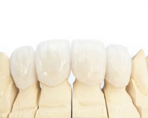 tips-from-dental-experts-for-taking-care-of-dental-crown-Glenroy-dentist