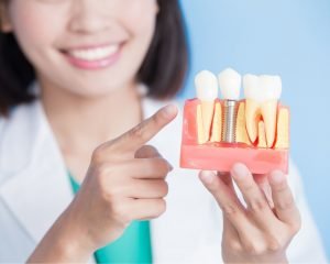 cost-and-procedure-for-a-single-tooth-dental-implant-glenroy-dentist