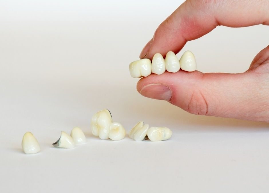 Dental Bonding vs Porcelain Veneers