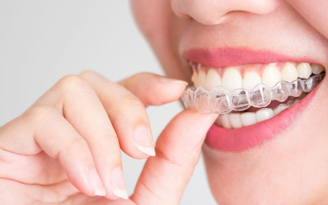 Invisalign VS Braces- Which One Is Better and Why?