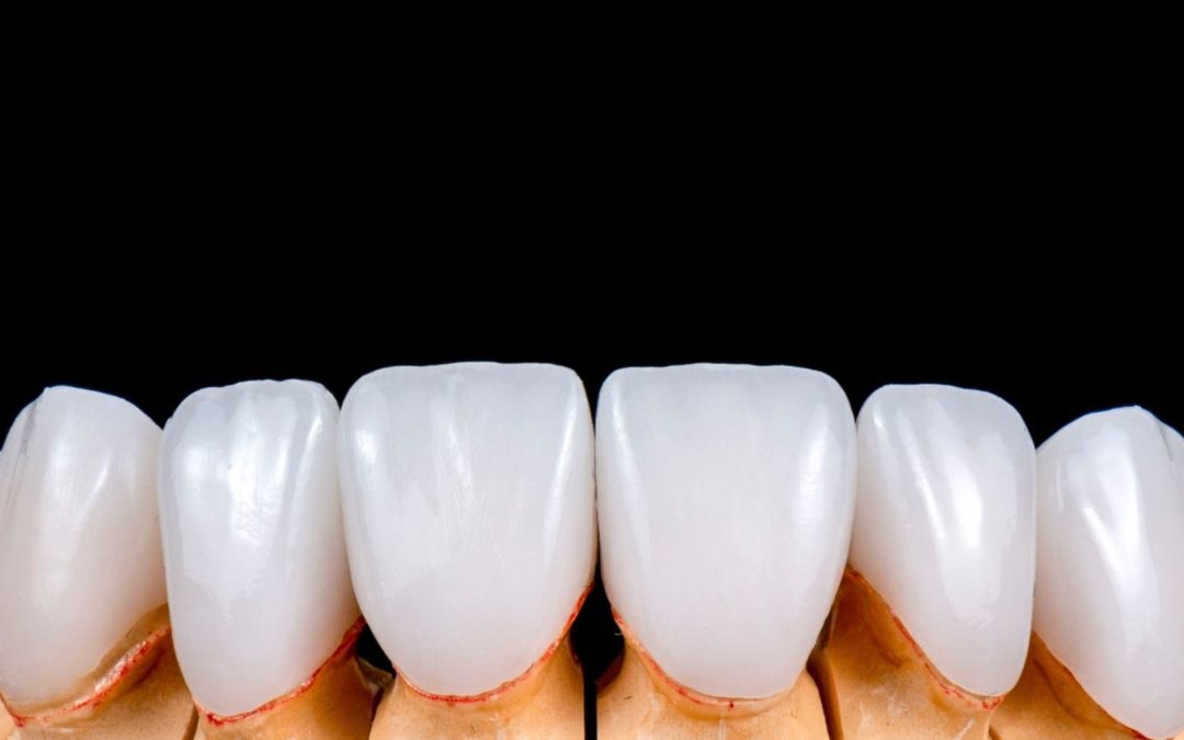 Veneers Vs Crowns- Which One Is Better For You?