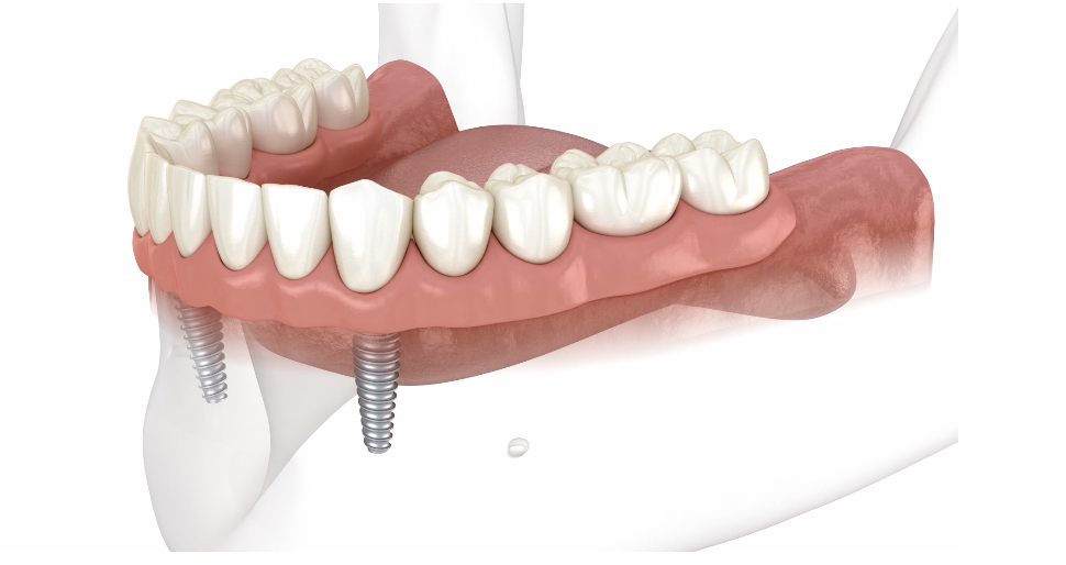 Snap on denture on 2 implants