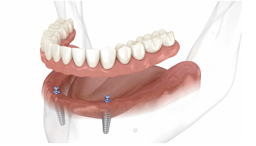 snap on dentures